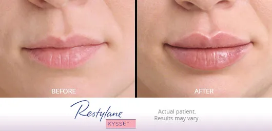 Restylane Kysse before and after 6