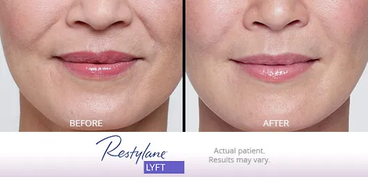 Restylane Lyft before and after 6