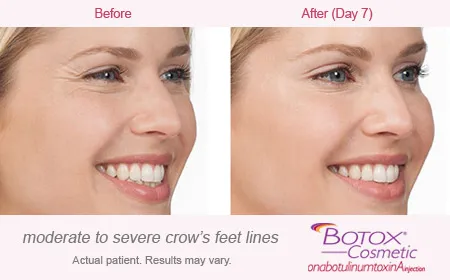 BOTOX Cosmetic for Crows Feet before and after 1