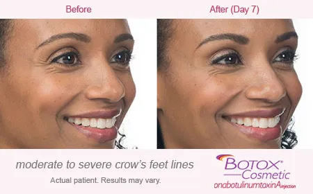 BOTOX Cosmetic for Crows Feet before and after 2