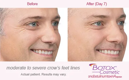 BOTOX Cosmetic for Crows Feet before and after 3
