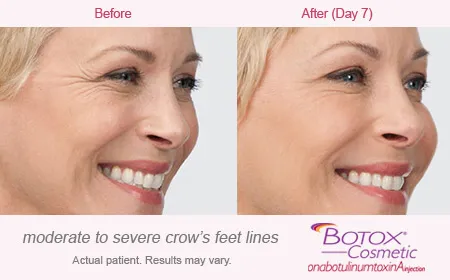 BOTOX Cosmetic for Crows Feet before and after 4