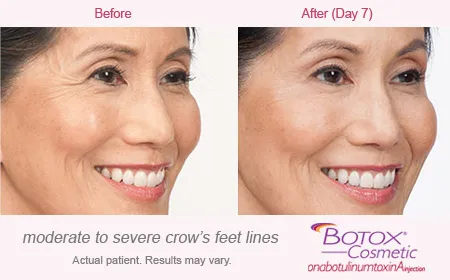 BOTOX Cosmetic for Crows Feet before and after 5