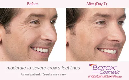 BOTOX Cosmetic for Crows Feet before and after 6