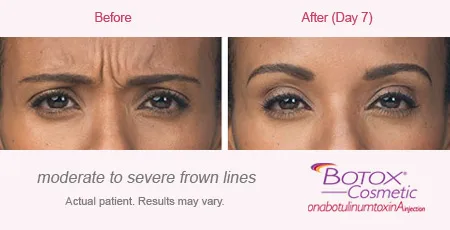 BOTOX Cosmetic for Frown Lines before and after 1