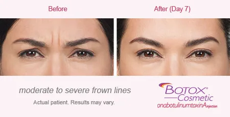 BOTOX Cosmetic for Frown Lines before and after 2