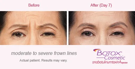 BOTOX Cosmetic for Frown Lines before and after 3