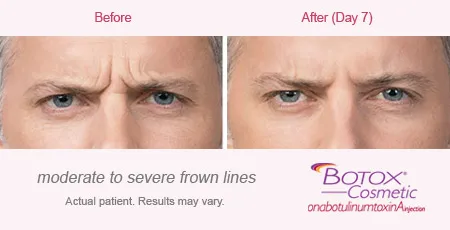 BOTOX Cosmetic for Frown Lines before and after 4