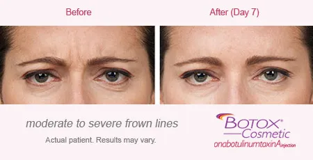 BOTOX Cosmetic for Frown Lines before and after 5