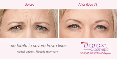 BOTOX Cosmetic for Frown Lines before and after 6