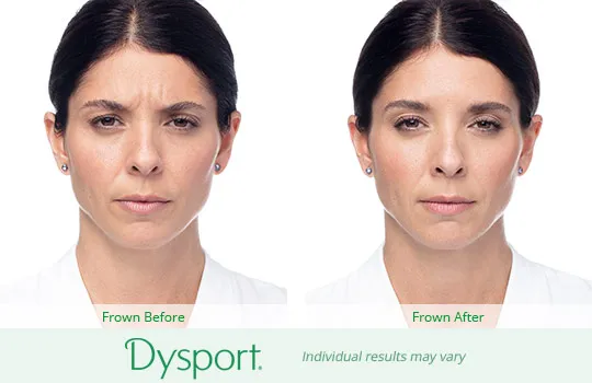 Dysport before and after 1
