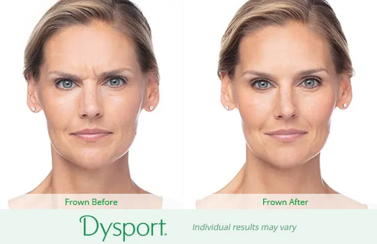 Dysport before and after 2