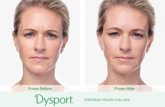 Dysport before and after 3