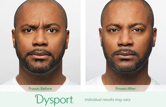 Dysport before and after 4