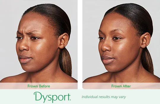 Dysport before and after 5