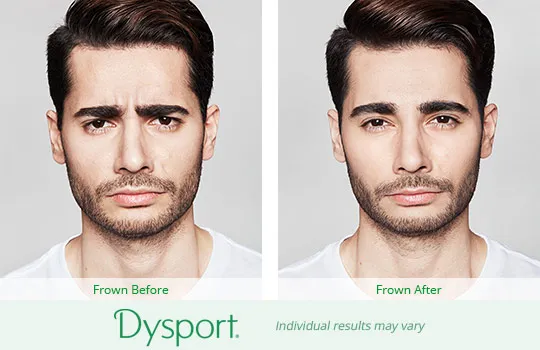 Dysport before and after 6