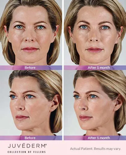 Juvederm before and after 1
