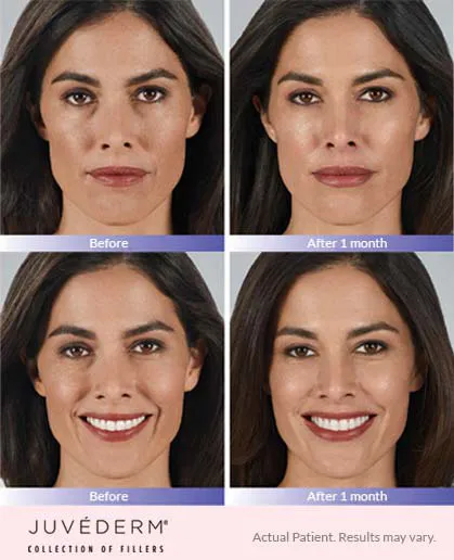 Juvederm before and after 2
