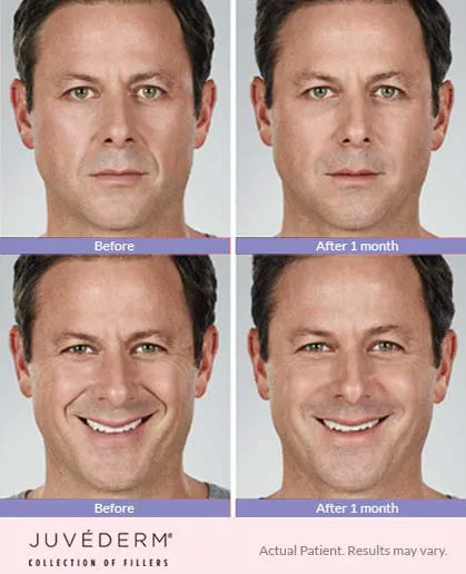 Juvederm before and after 3