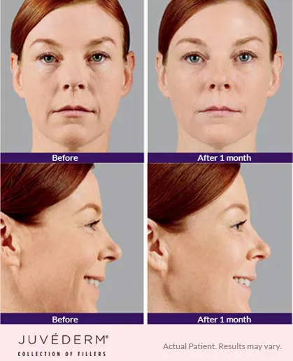 Juvederm before and after 5
