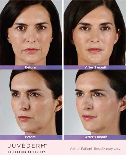 Juvederm before and after 6