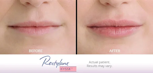 Restylane Kysse before and after 5