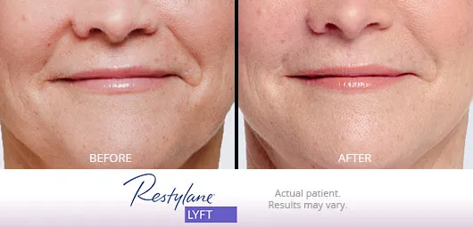 Restylane Lyft before and after 6