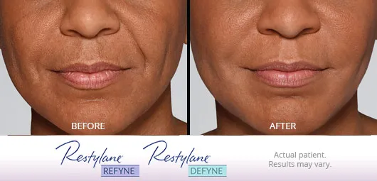 Restylane Refyne Defyne before and after 4
