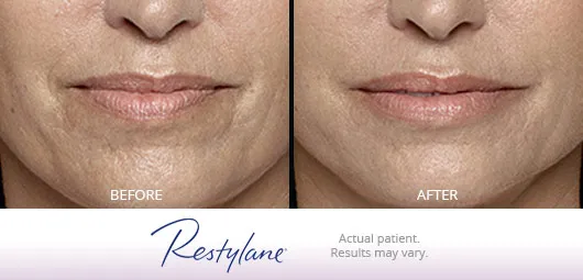Restylane before and after 1