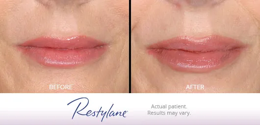 Restylane before and after 2