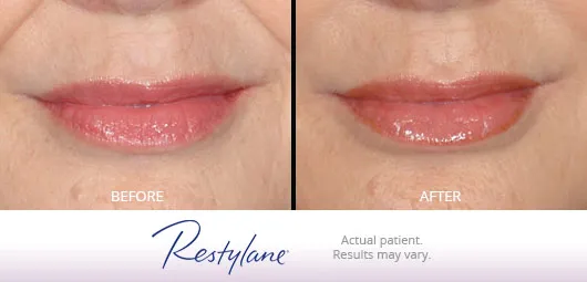 Restylane before and after 3