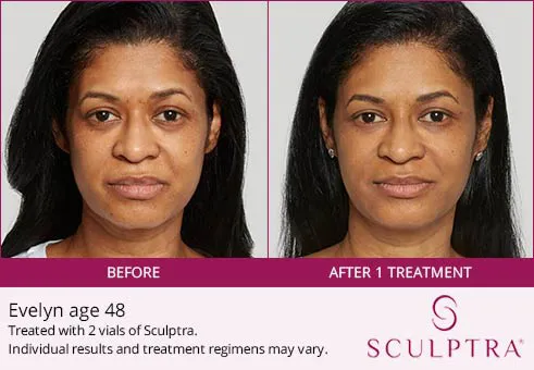 Sculptra before and after 1