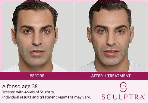 Sculptra before and after 2