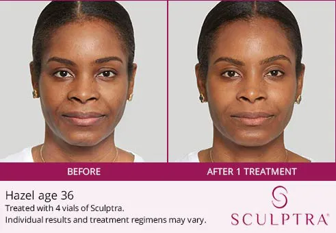 Sculptra before and after 3