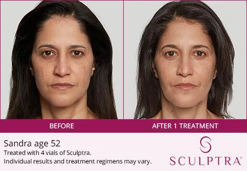 Sculptra before and after 4