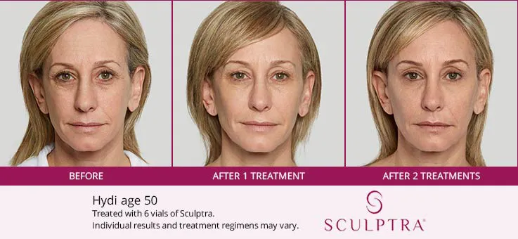 Sculptra before and after 5