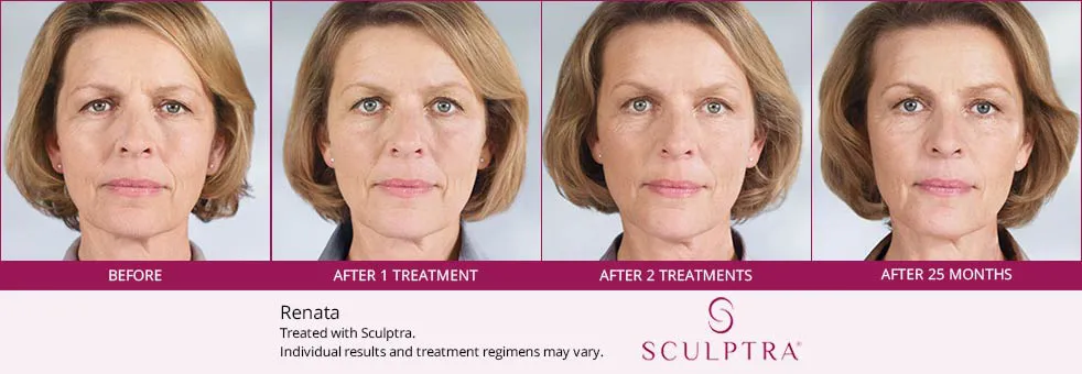 Sculptra before and after 6
